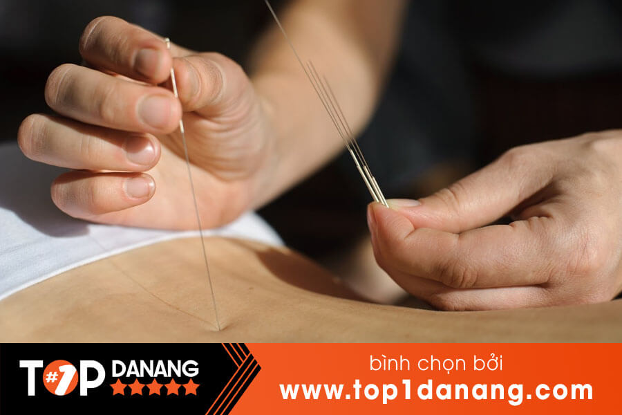 Châm cứu Đà Nẵng