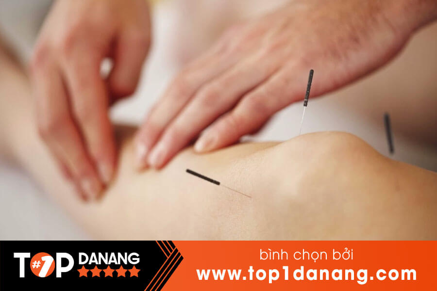 Châm cứu tại Đà Nẵng