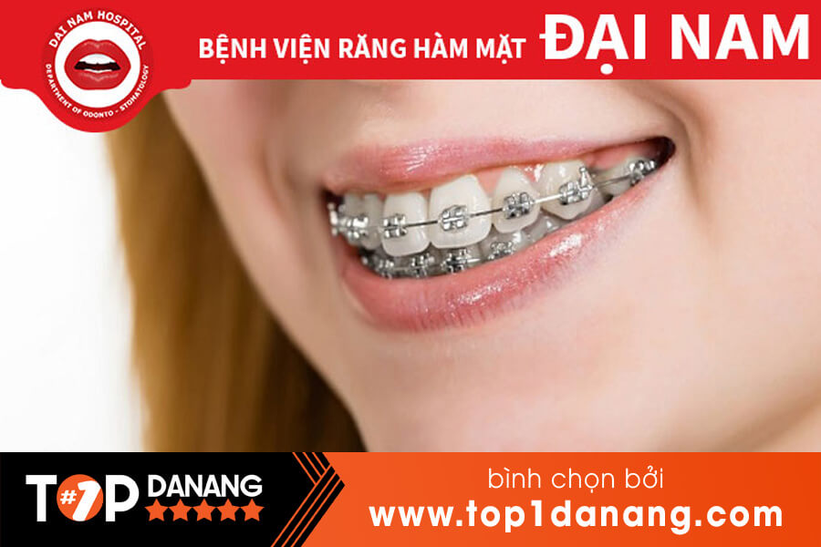 Niềng răng giá rẻ